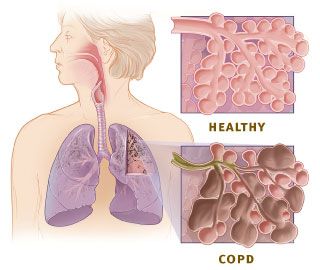 COPD Healthy Alveoli and Damaged Alveoli